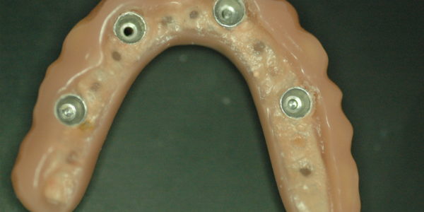 Cara interna de la prótesis donde se aprecia la estructura metálica interna