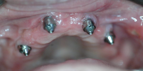 4 implantes en maxilar superior