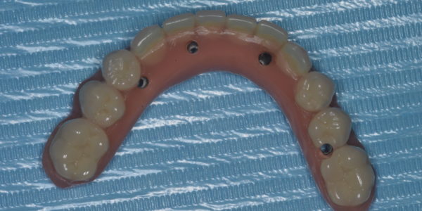 Protesis fuera de boca donde se ven zonas de otornillado
