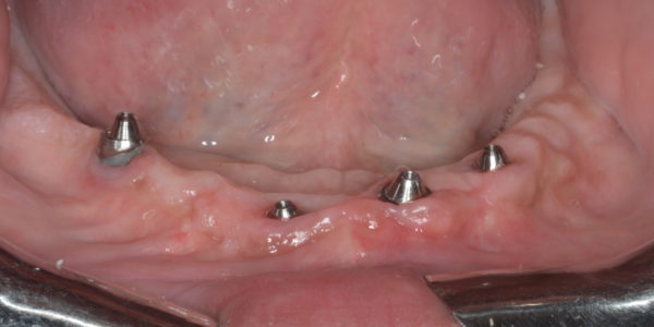 Implantes en maxilar inferior