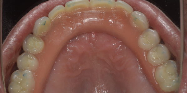 Prótesis superior atornillada en boca